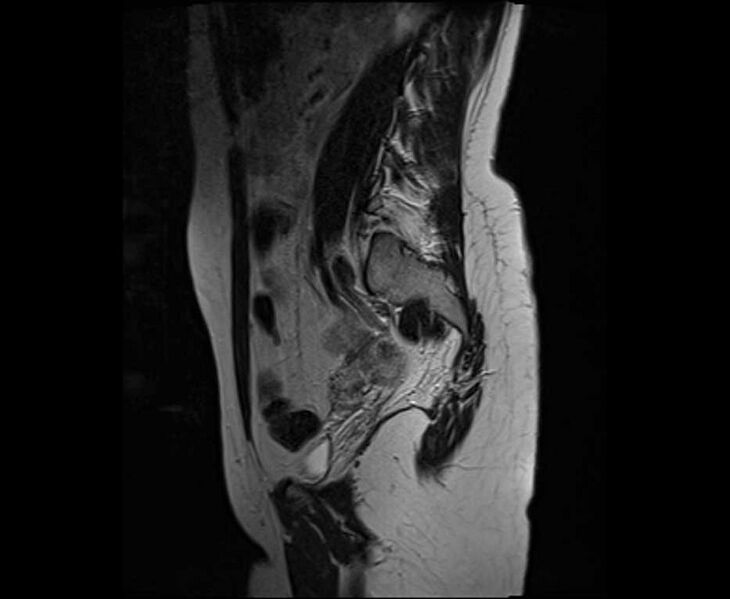 File:Bicornuate bicollis uterus (Radiopaedia 61626-69616 Sagittal T2 28).jpg