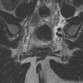 Bicornuate uterus (Radiopaedia 24677-24949 Coronal T2 15).jpg
