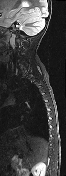 File:Bilateral Sprengel deformity with Klippel-Feil syndrome (Radiopaedia 66395-75650 Sagittal STIR 1).jpg