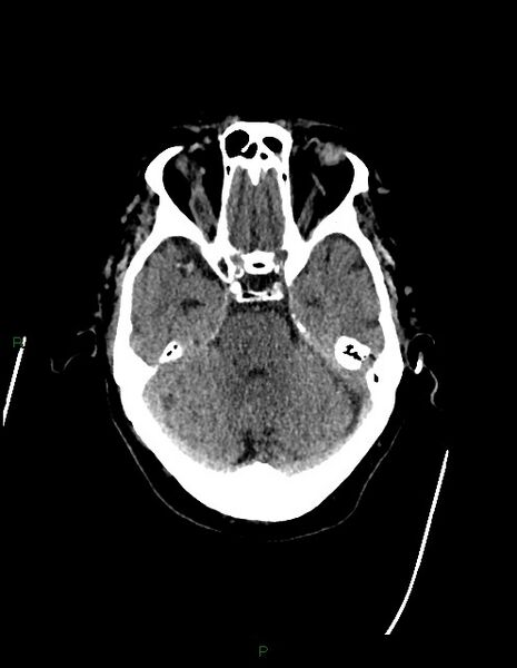 File:Bilateral acute middle cerebral artery territory infarcts (Radiopaedia 77319-89401 Axial non-contrast 27).jpg