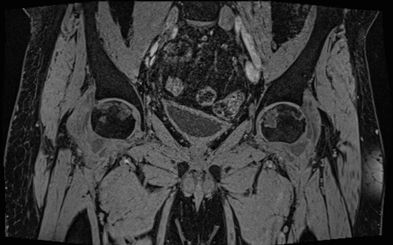 File:Bilateral avascular necrosis of femoral head (Radiopaedia 77116-89078 Coronal T2 we 53).jpg