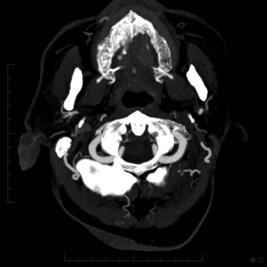 Bilateral chronic common carotid occlusion (Radiopaedia 50849-56362 D 29).jpg