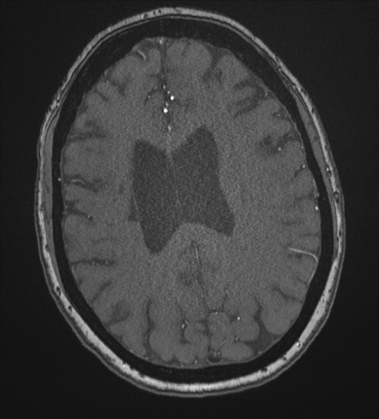 File:Bilateral fetal posterior communicating arteries (Radiopaedia 41286-44102 Axial MRA 150).png