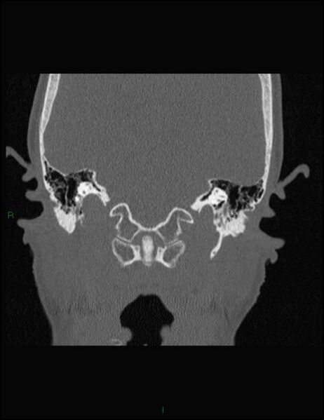 File:Bilateral frontal mucoceles (Radiopaedia 82352-96454 Coronal 321).jpg