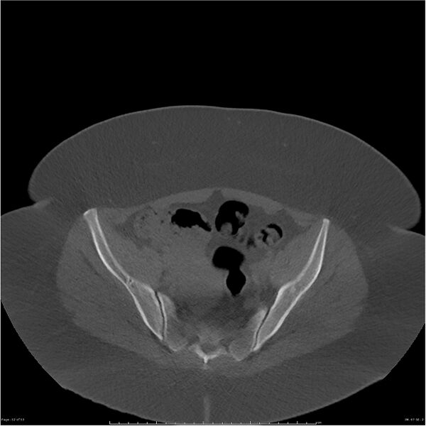 File:Bilateral lumbar ribs (Radiopaedia 25862-26010 bone window 52).jpg