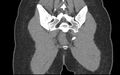 Bilateral mature cystic ovarian teratoma (Radiopaedia 88821-105592 Coronal non-contrast 41).jpg
