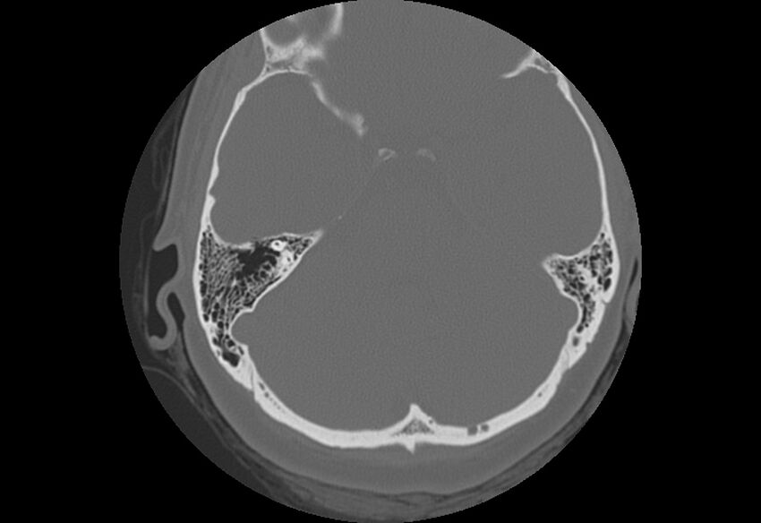 Bilateral otospongiosis (Radiopaedia 35447-36940 B 45).jpg