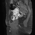 Bilateral ovarian endometriomas (Radiopaedia 87085-103347 F 7).jpg