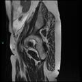 Bilateral ovarian fibroma (Radiopaedia 44568-48293 Sagittal T2 3).jpg