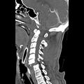 Bilateral perched facets with cord injury (Radiopaedia 45587-49713 B 24).jpg