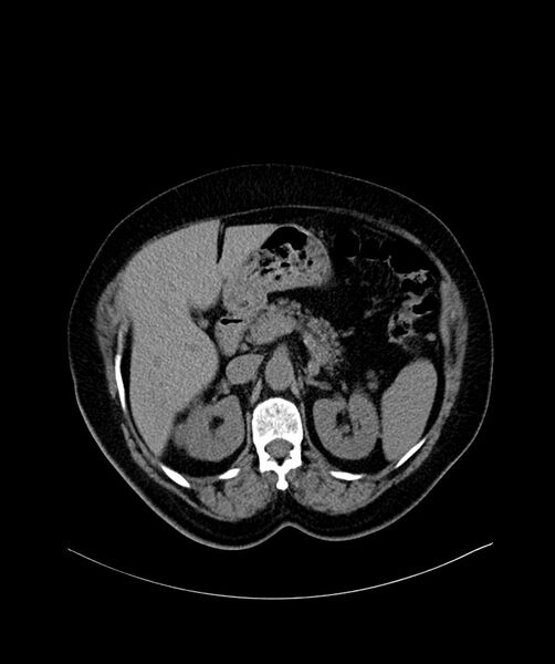 File:Bilateral sporadic synchronous clear cell renal cell carcinoma (Radiopaedia 85035-100572 Axial non-contrast 21).jpg