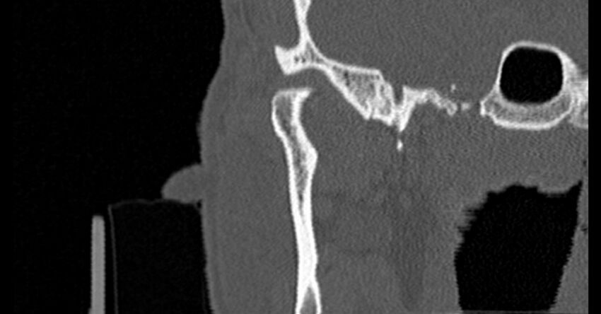 Bilateral temporal bone fractures (Radiopaedia 29482-29970 Coronal non-contrast 34).jpg