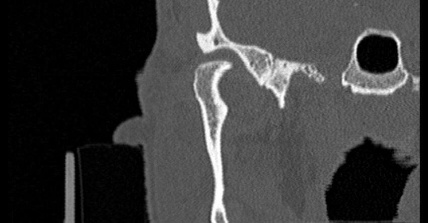 Bilateral temporal bone fractures (Radiopaedia 29482-29970 Coronal non-contrast 39).jpg