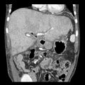 Biliary necrosis - liver transplant (Radiopaedia 21876-21846 C 15).jpg