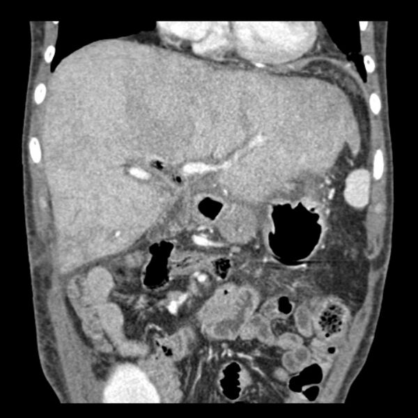 File:Biliary necrosis - liver transplant (Radiopaedia 21876-21846 C 15).jpg