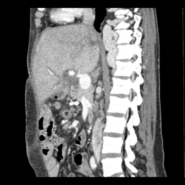 File:Biliary necrosis - liver transplant (Radiopaedia 21876-21846 D 10).jpg