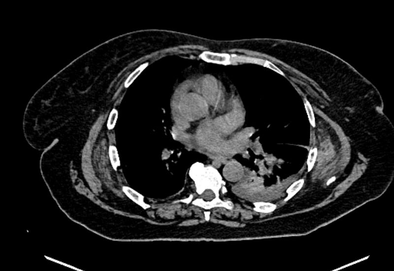 File:Biliary pancreatitis (Radiopaedia 72289-82823 Axial non-contrast 1).jpg