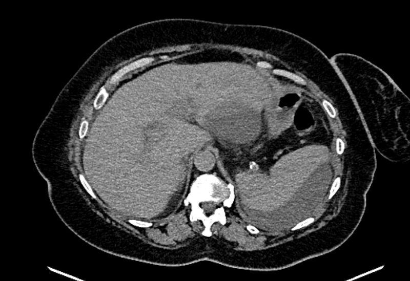 File:Biliary pancreatitis (Radiopaedia 72289-82823 Axial non-contrast 70).jpg