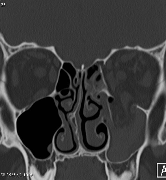 File:Blowout orbital fracture (Radiopaedia 4880-6817 Coronal bone window 1).jpg