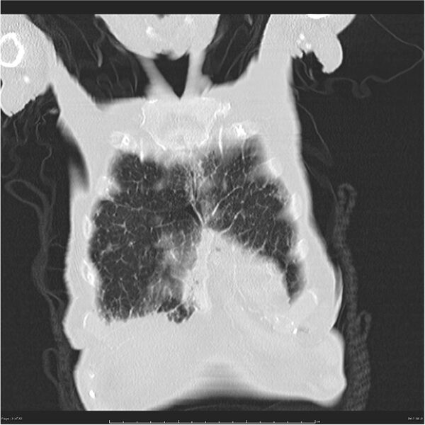 File:Boerhaave syndrome (Radiopaedia 26240-26362 Coronal lung window 3).jpg