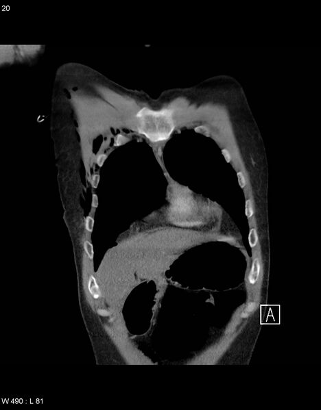 File:Boerhaave syndrome with tension pneumothorax (Radiopaedia 56794-63605 B 5).jpg