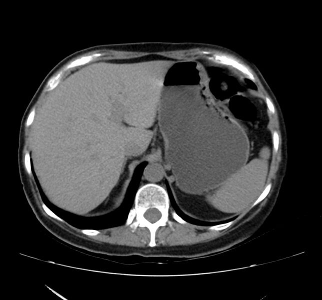 File:Bosniak renal cyst - type IV (Radiopaedia 22929-22953 Axial non-contrast 10).jpg