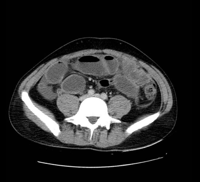 File:Bowel obstruction from colon carcinoma (Radiopaedia 22995-23028 A 56).jpg
