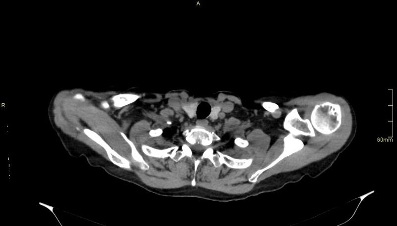 File:Brachial artery foreign body (Radiopaedia 54583-60820 Axial non-contrast 9).jpg