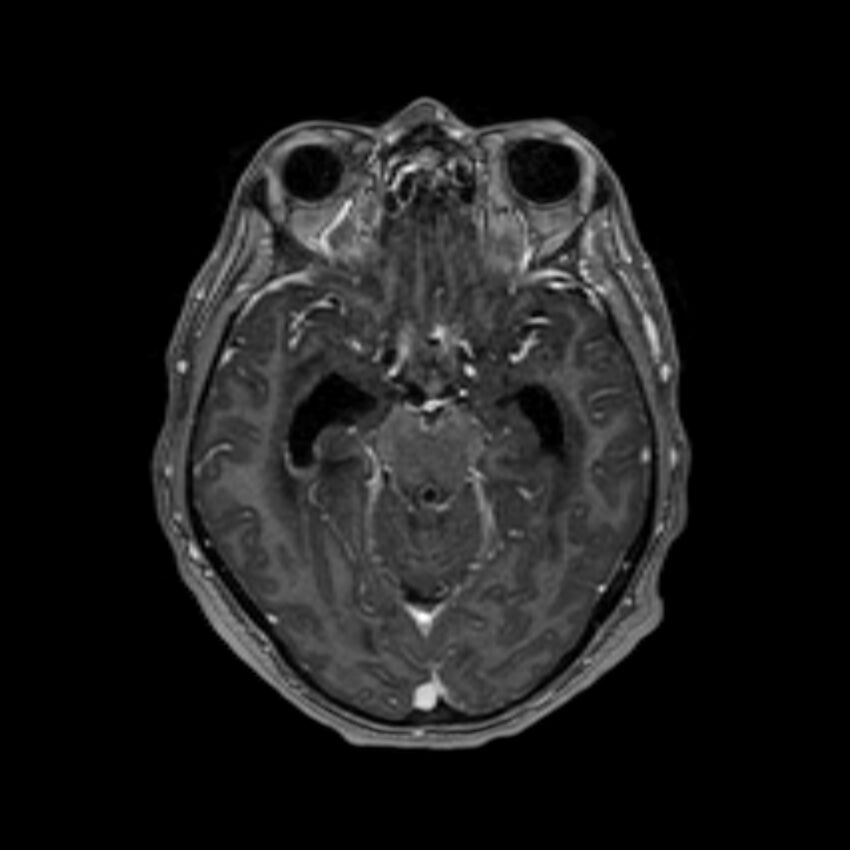 Brain abscess complicated by intraventricular rupture and ventriculitis (Radiopaedia 82434-96577 Axial T1 C+ 24).jpg