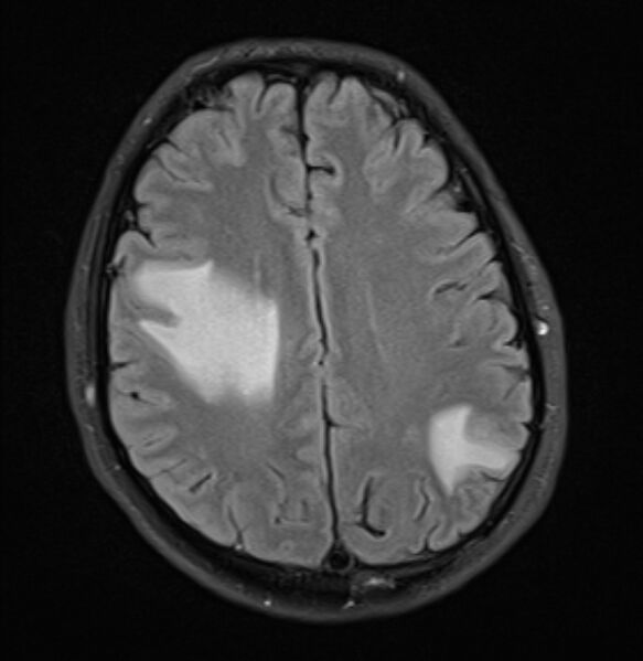 File:Brain metastases - lung cancer primary (Radiopaedia 75060-86115 Axial FLAIR 17).jpg