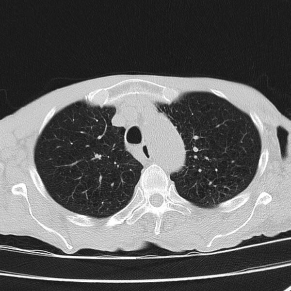 File:Brain metastases from lung cancer (Radiopaedia 27849-28093 Axial lung window 16).jpg
