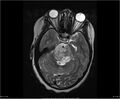 Brainstem glioma (Radiopaedia 21819-21775 Axial T2 13).jpg