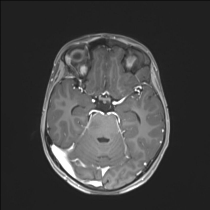 Brainstem glioma (Radiopaedia 70548-80674 Axial T1 C+ 63).jpg