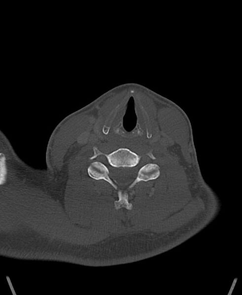 File:Branchial cleft cyst (Radiopaedia 31167-31875 Axial bone window 48).jpg