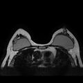 Breast implants - MRI (Radiopaedia 26864-27035 Axial T2 32).jpg