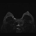 Breast implants - MRI (Radiopaedia 26864-27035 T2 SPAIR 33).jpg