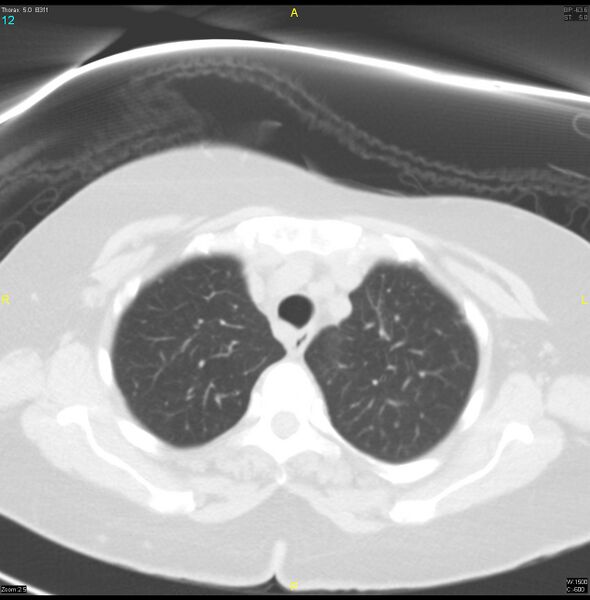 File:Breast primary with lung and bone metastases (Radiopaedia 40620-43228 Axial lung window 12).jpg