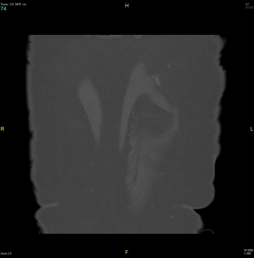 Breast primary with lung and bone metastases (Radiopaedia 40620-43228 bone window 74).jpg