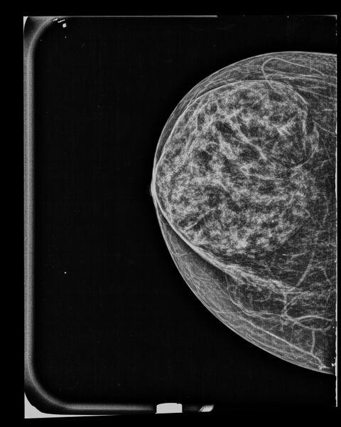 File:Breast within a breast sign of breast hamartoma (Radiopaedia 56853-63682 CC 1).jpg