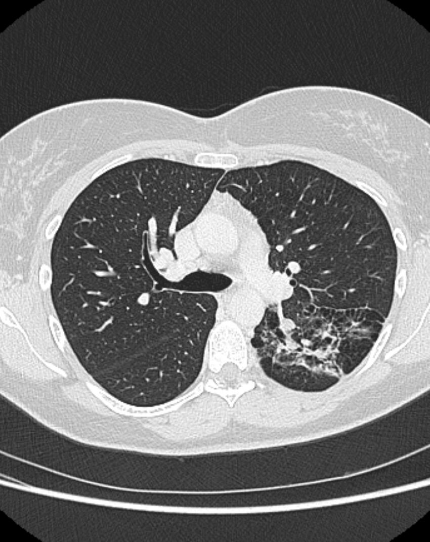 Bronchial atresia (Radiopaedia 50007-55297 Axial lung window 39).jpg