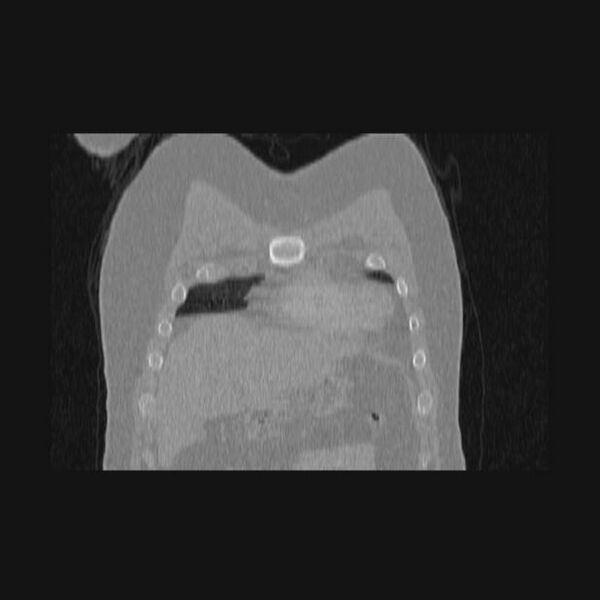 File:Bronchial atresia (Radiopaedia 60685-68439 Coronal lung window 67).jpg