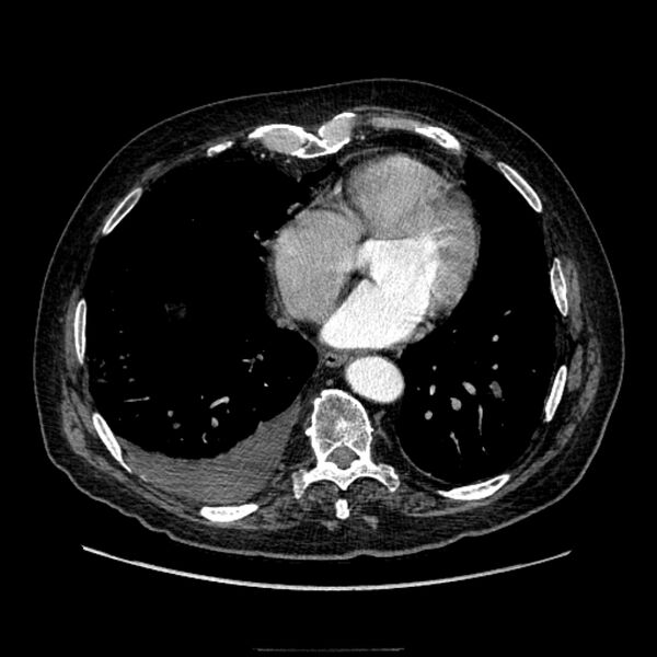 File:Bronchogenic adenocarcinoma and pulmonary embolism (Radiopaedia 9097-9806 D 42).jpg