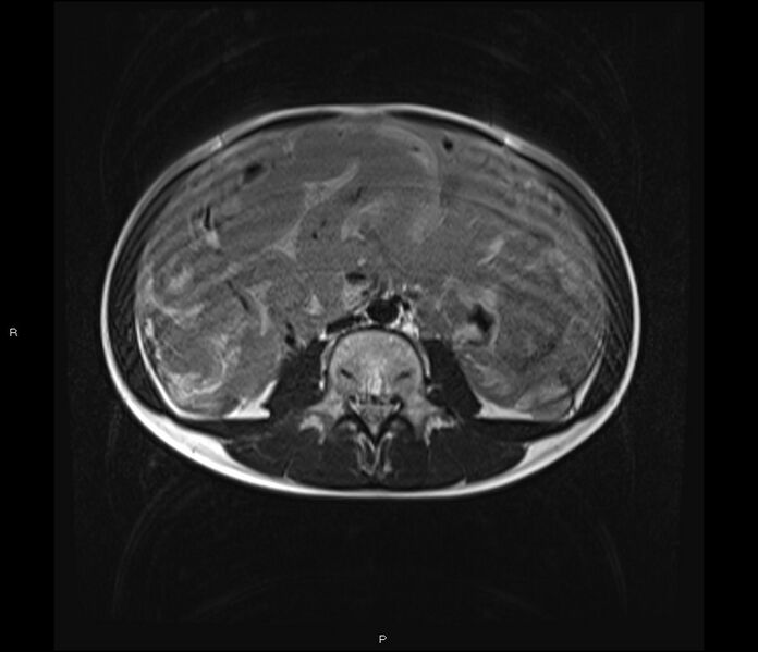 File:Burkitt lymphoma (bowel) (Radiopaedia 68839-78557 Axial T2 36).jpg