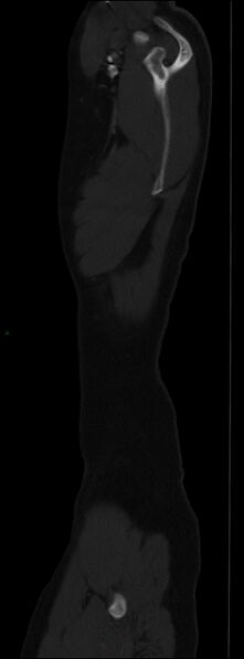 File:Burst fracture (Radiopaedia 83168-97542 Sagittal bone window 21).jpg