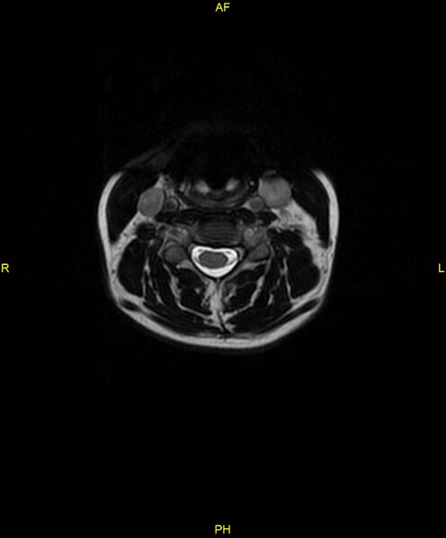 File:C5 nerve sheath tumor (Radiopaedia 85777-101596 Axial T2 27).jpg