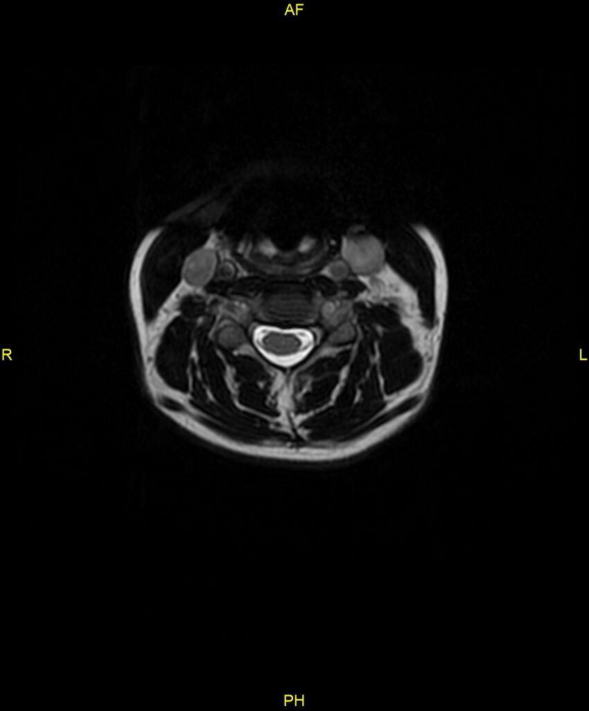 C5 nerve sheath tumor (Radiopaedia 85777-101596 Axial T2 27).jpg