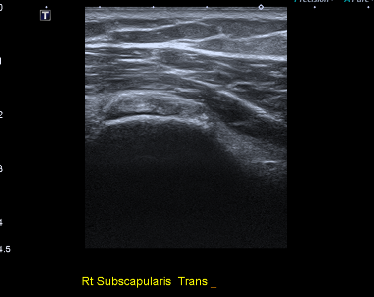 File:Calcific tendinitis (ruptured) (Radiopaedia 56393-63053 A 26).png