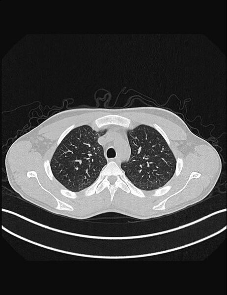 File:Calcifying pulmonary metastases (Radiopaedia 33359-34396 Axial lung window 16).jpg