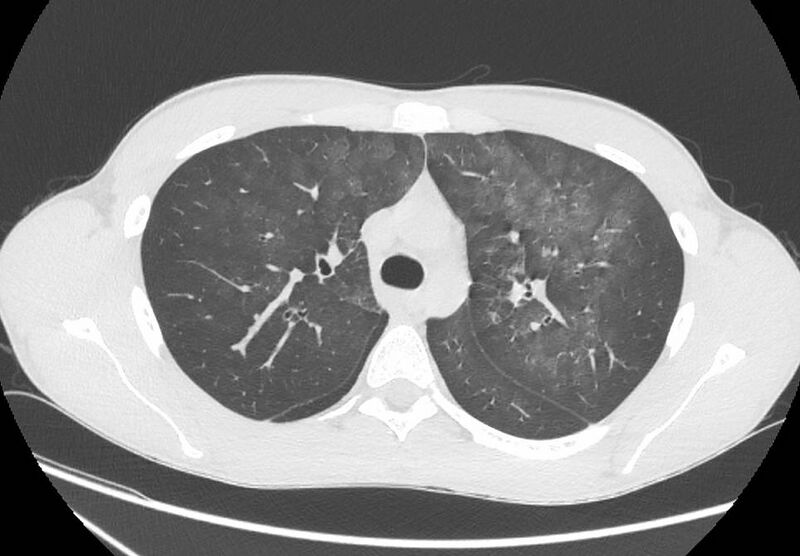 File:Cannabis-induced diffuse alveolar hemorrhage (Radiopaedia 89834-106946 Axial lung window 37).jpg