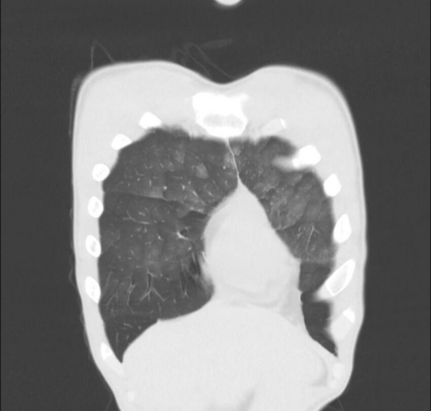 Cannabis-induced diffuse alveolar hemorrhage (Radiopaedia 89834-106946 Coronal lung window 77).jpg